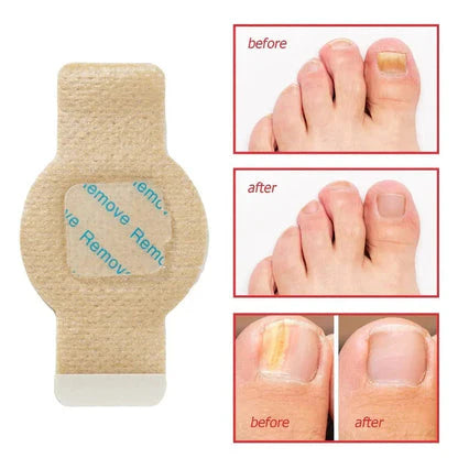 NailHeal™ - Fungal Nail Patches 🌿💅 ( Buy 1 Get 1 Free🔥🔥)